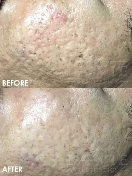 ="MRF MRF (RF Microneedling) Promotion